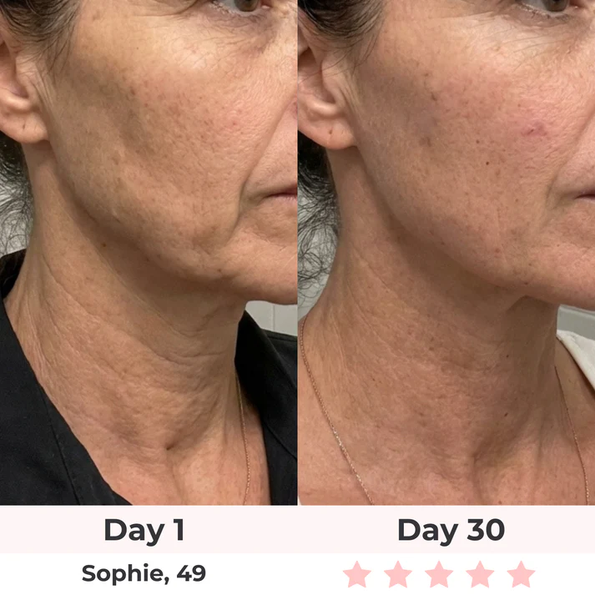 Avant après Sculpteur Facial LED - Sophie 49 ans - Jour 1 vs Jour 30