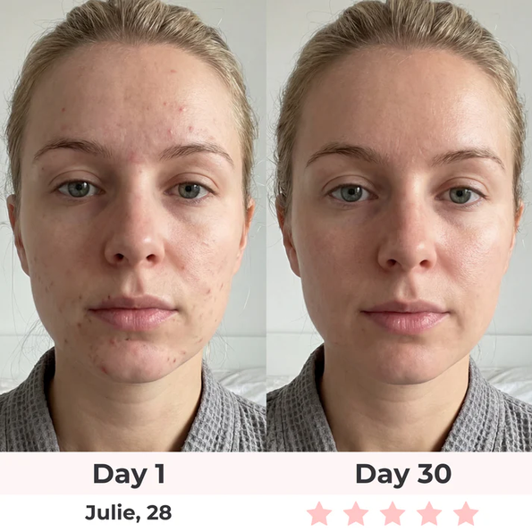 Avant après masque LED - Julie 28 ans - Jour 1 vs Jour 30