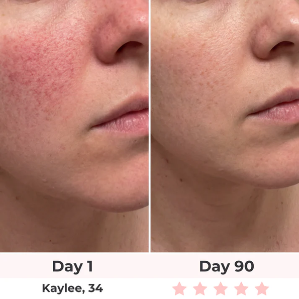 Avant après masque LED - Kaylee 34 ans - Jour 1 vs Jour 90