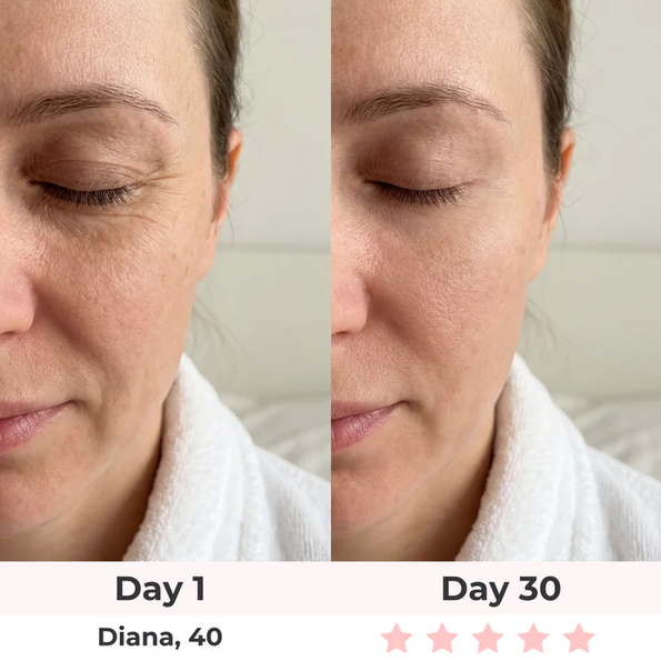 Avant après masque LED - Diana 40 ans - Jour 1 vs Jour 30
